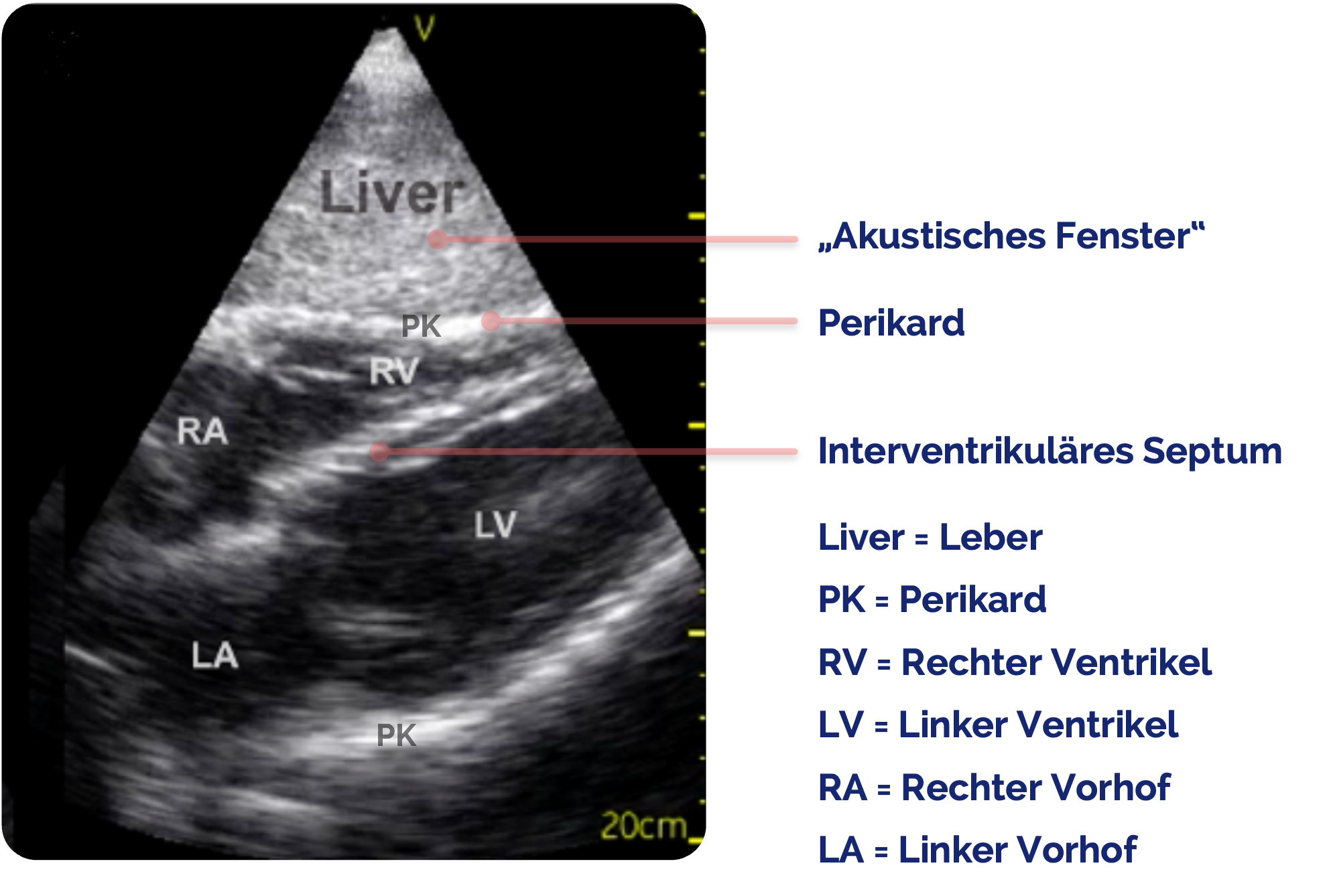 Normalbefund des Herzens in der subxiphoidalen Ansicht