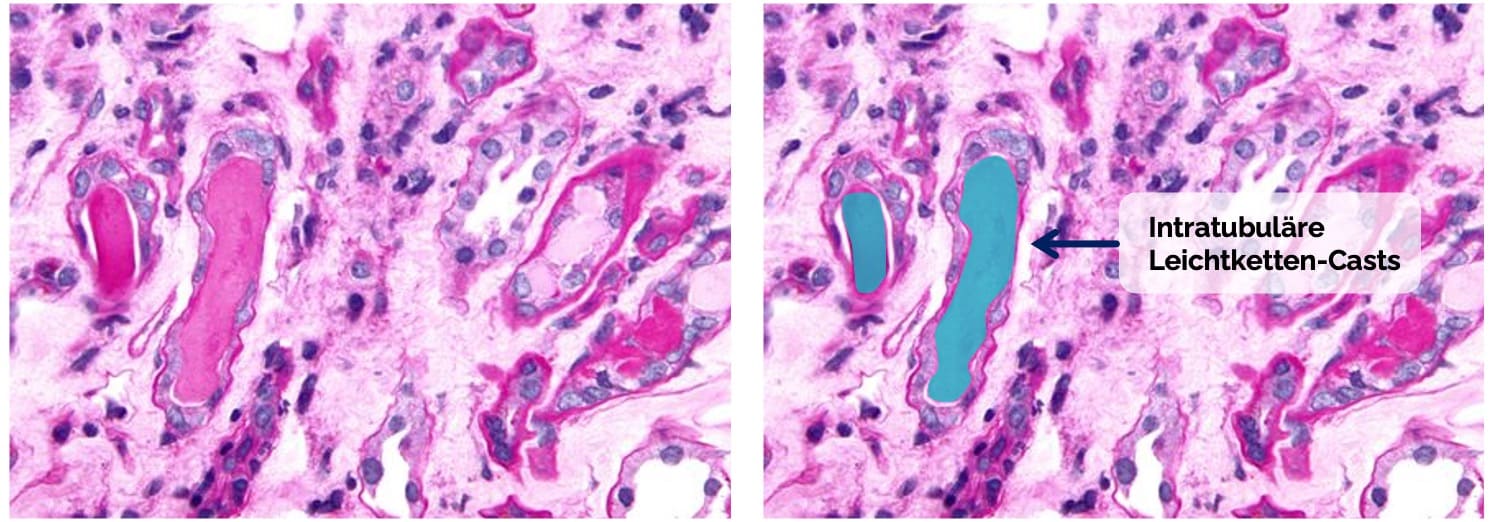Cast-Nephropathie bei Myelomniere
