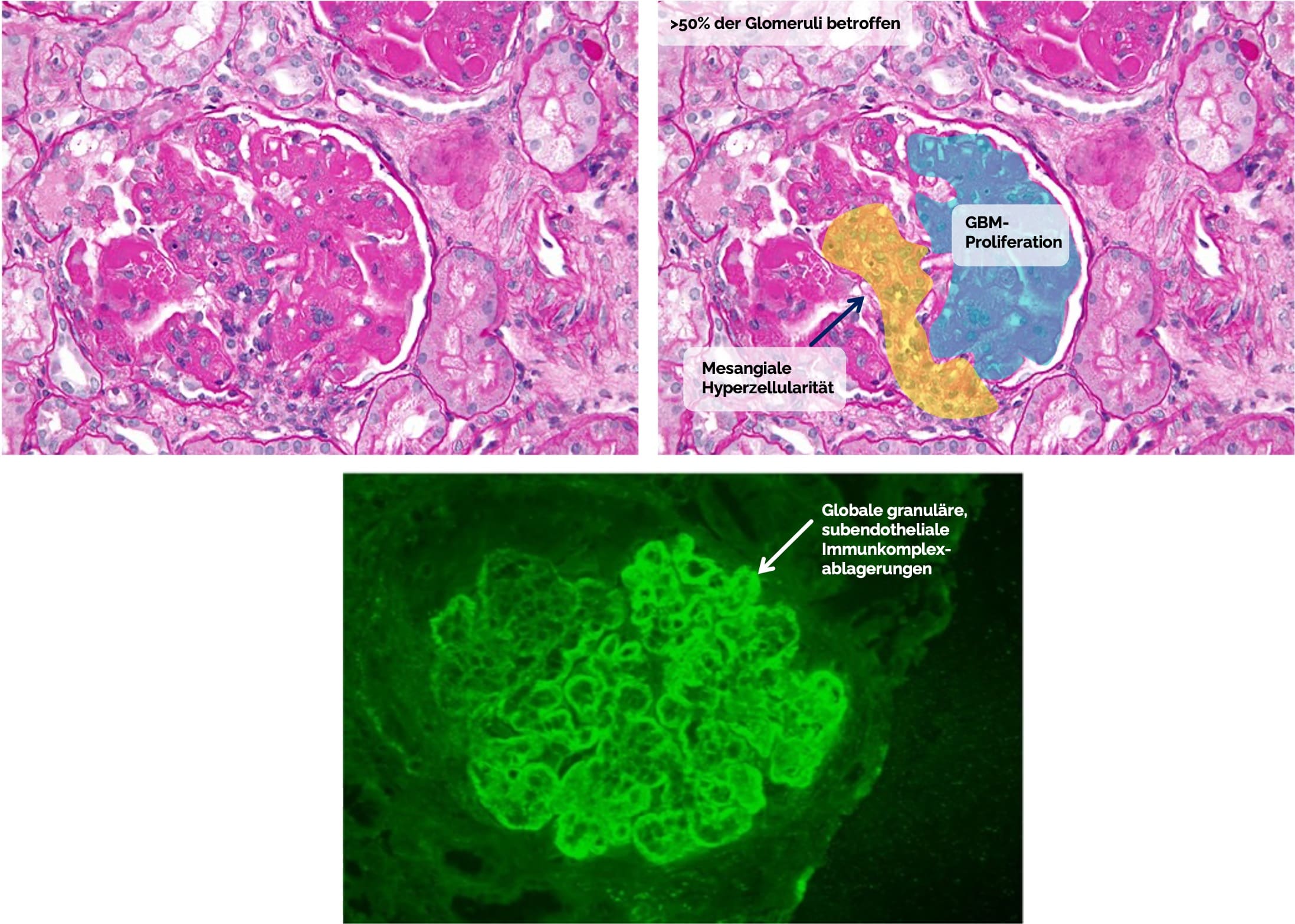 Diffuse Lupusnephritis (Klasse 4)