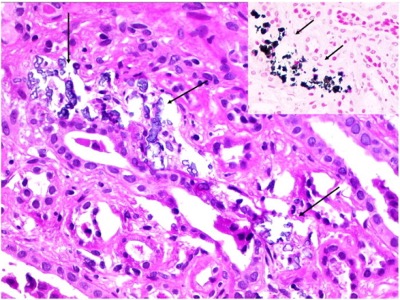 Nephrokalzinose