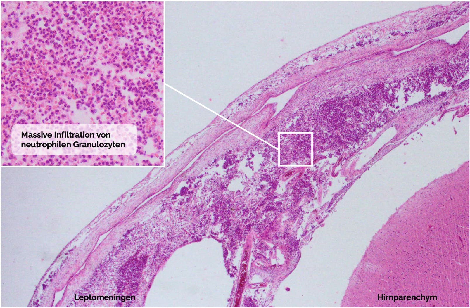 Bakterielle Meningitis Mikroskopie
