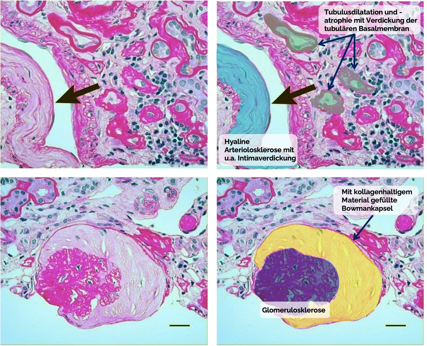 Hypertensive Nephropathie