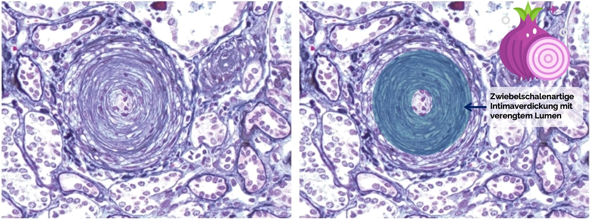 Sklerodermatische Nephropathie