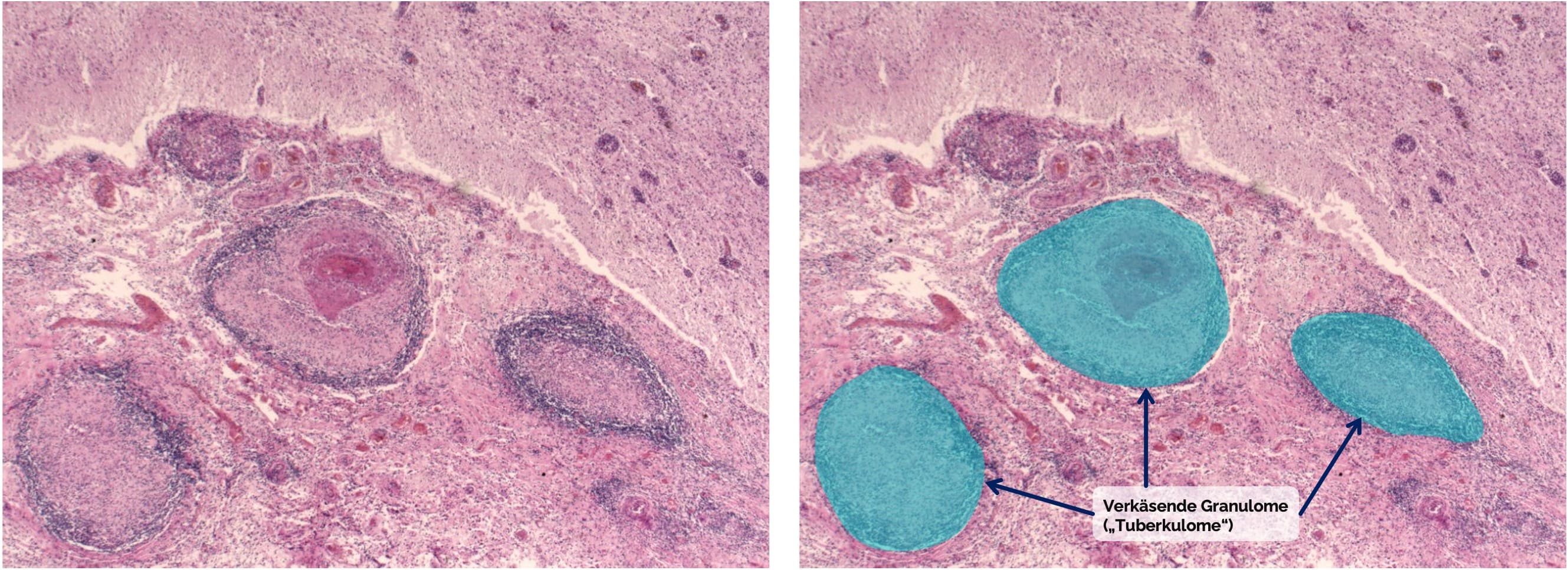 Tuberkulöse Meningitis Mikroskopie