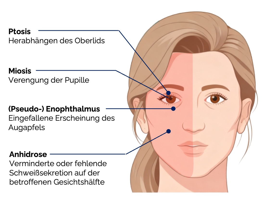 Horner-Syndrom (typische Symptome)