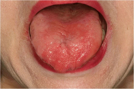 Hunter-Glossitis