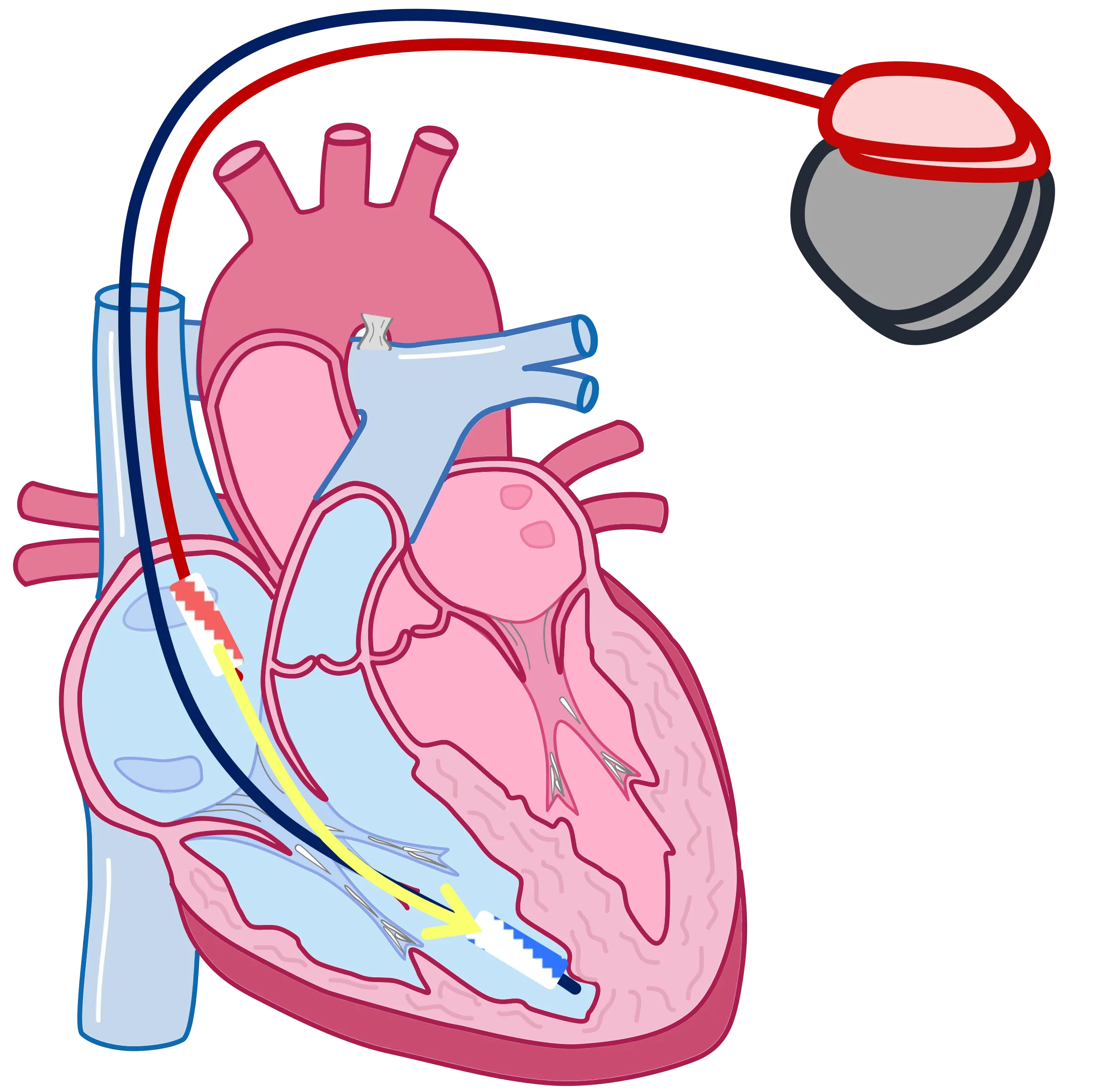 Antitachykarder Herzschrittmacher (implantierbarer Cardioverter-Defibrillator/ICD)