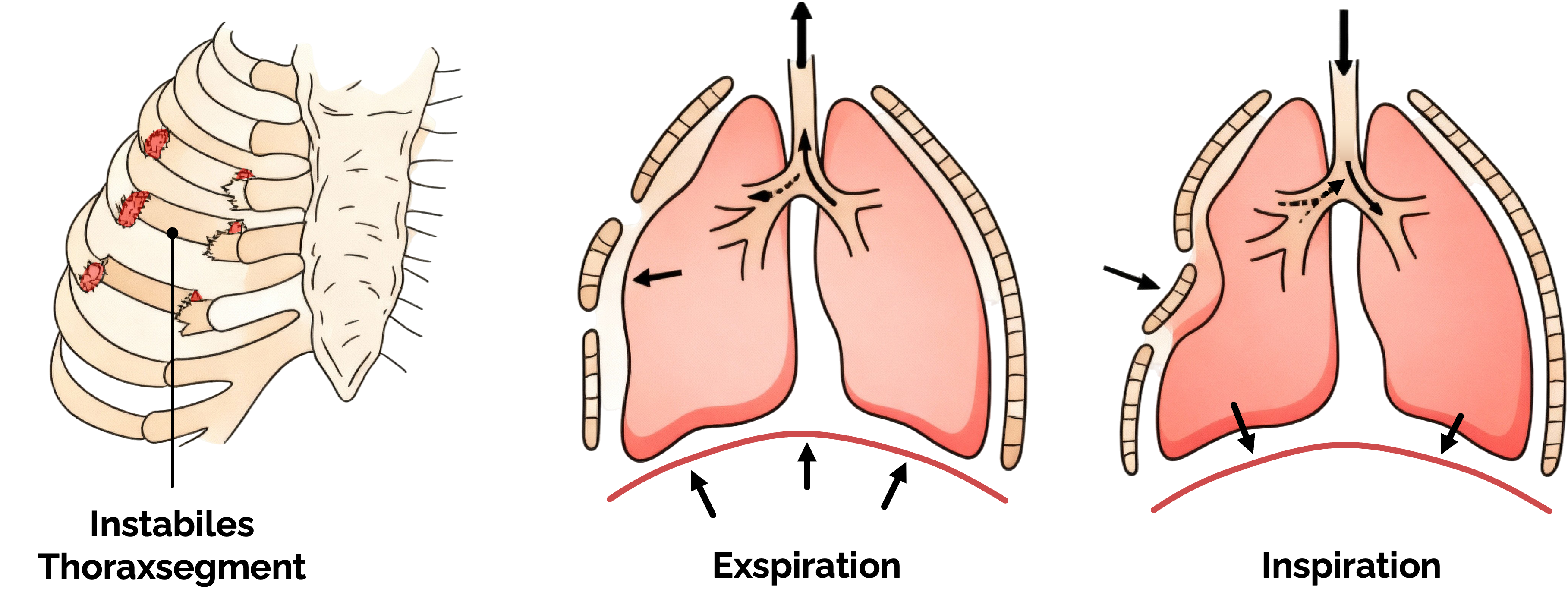 Instabiler Thorax (Flail Chest) mit paradoxen Atembewegungen