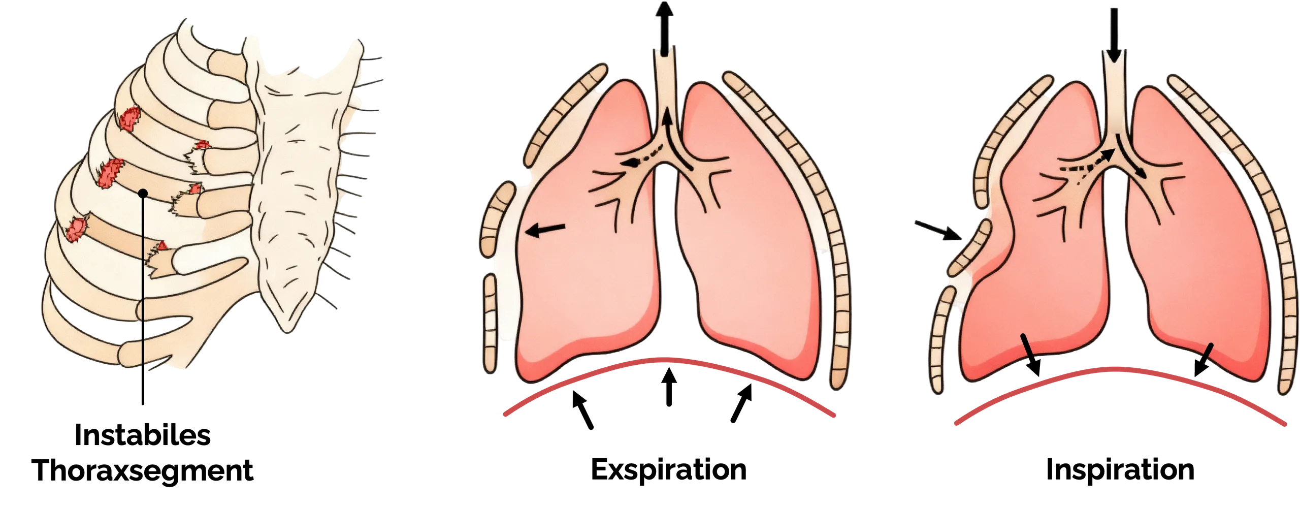 Instabiler Thorax (Flail Chest) mit paradoxen Atembewegungen