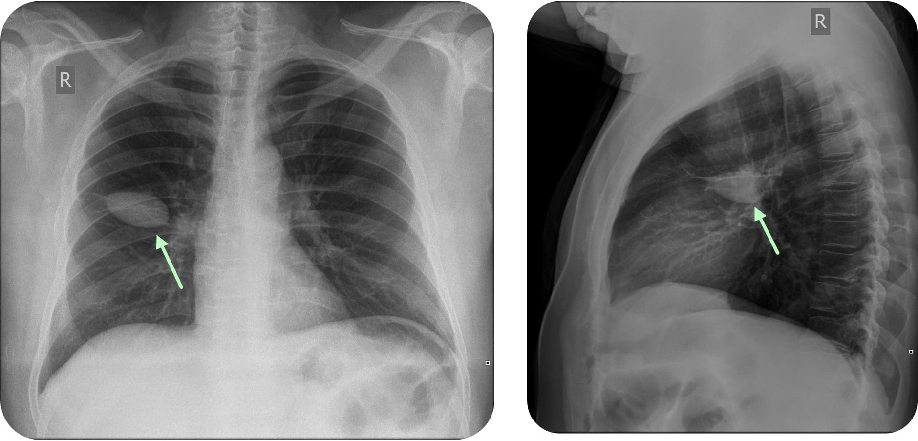 Interlobärerguss im Röntgen-Thorax