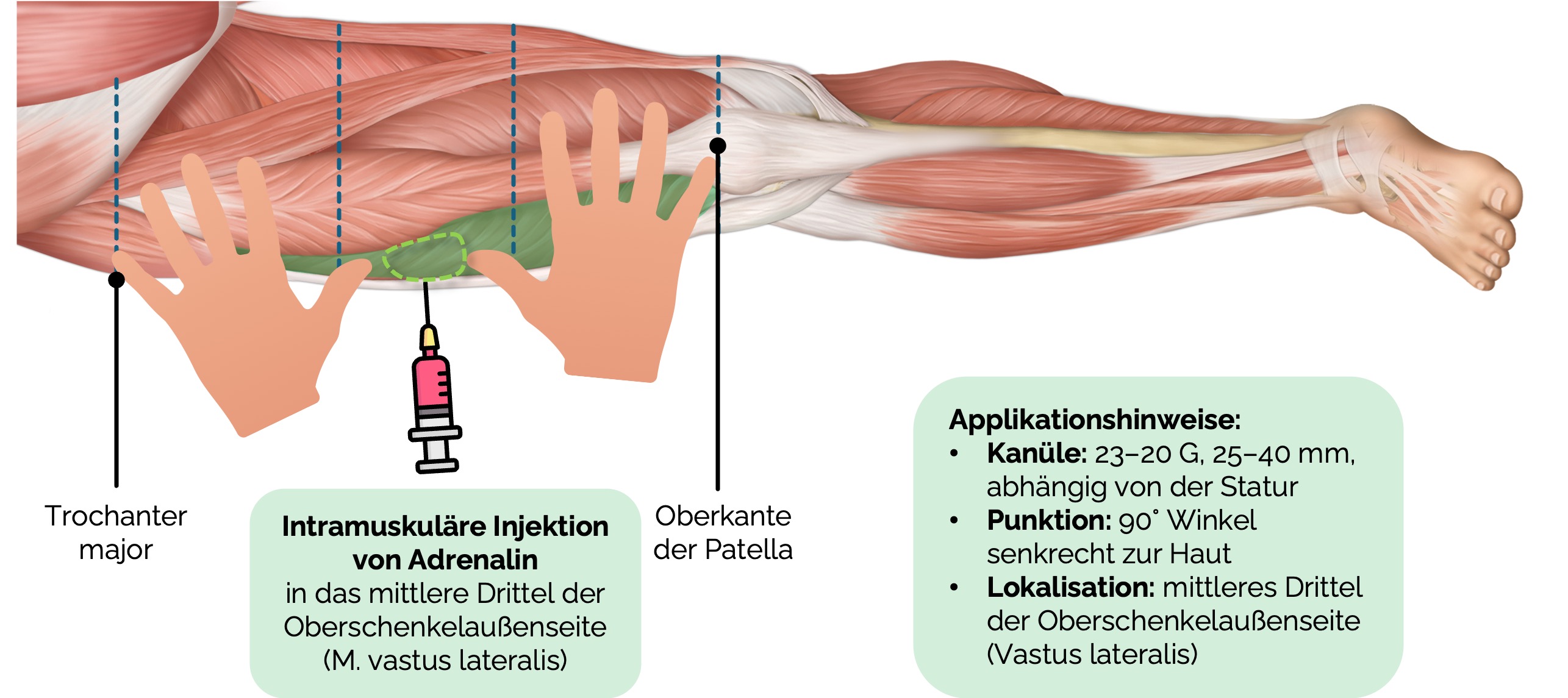 Intramuskuläre Adrenalin-Injektion