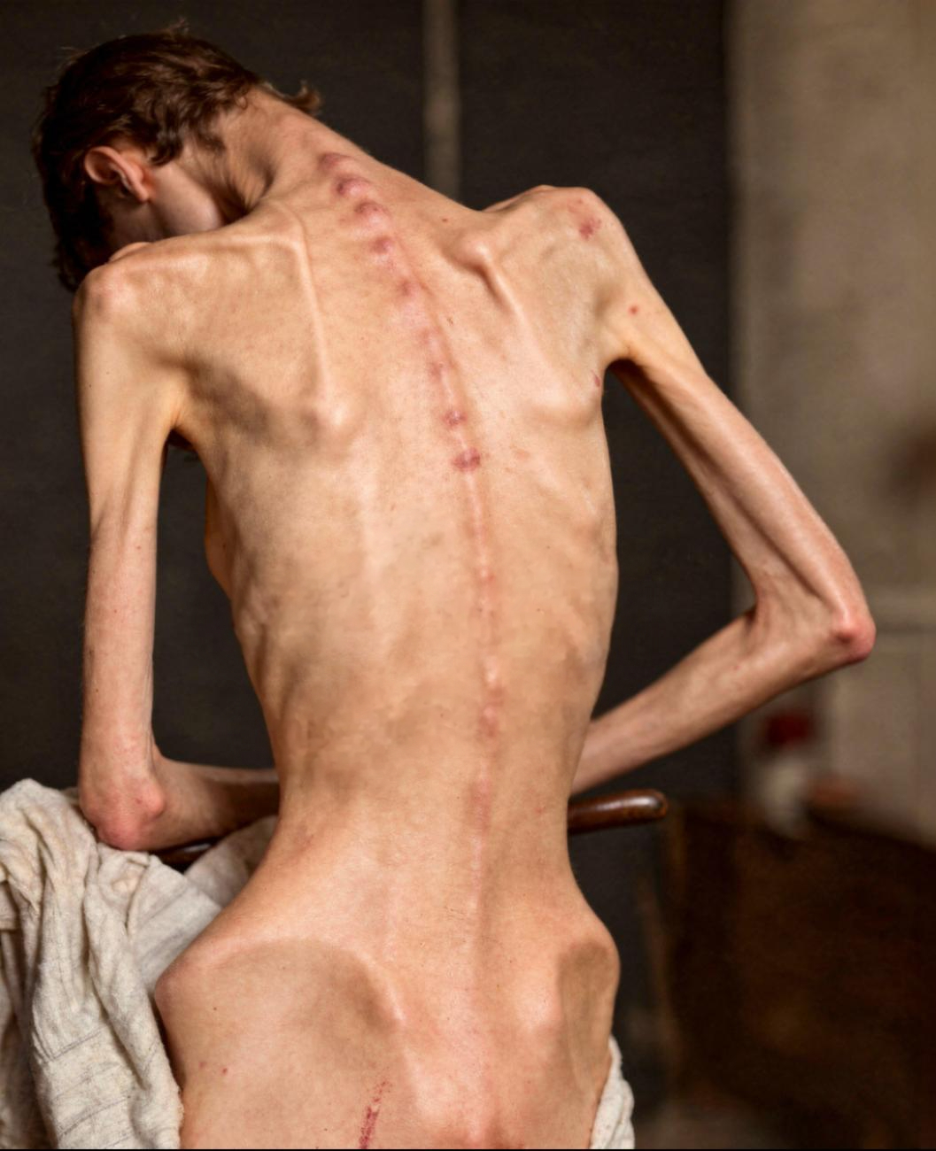 Anorexia nervosa mit ausgeprägter Kachexie