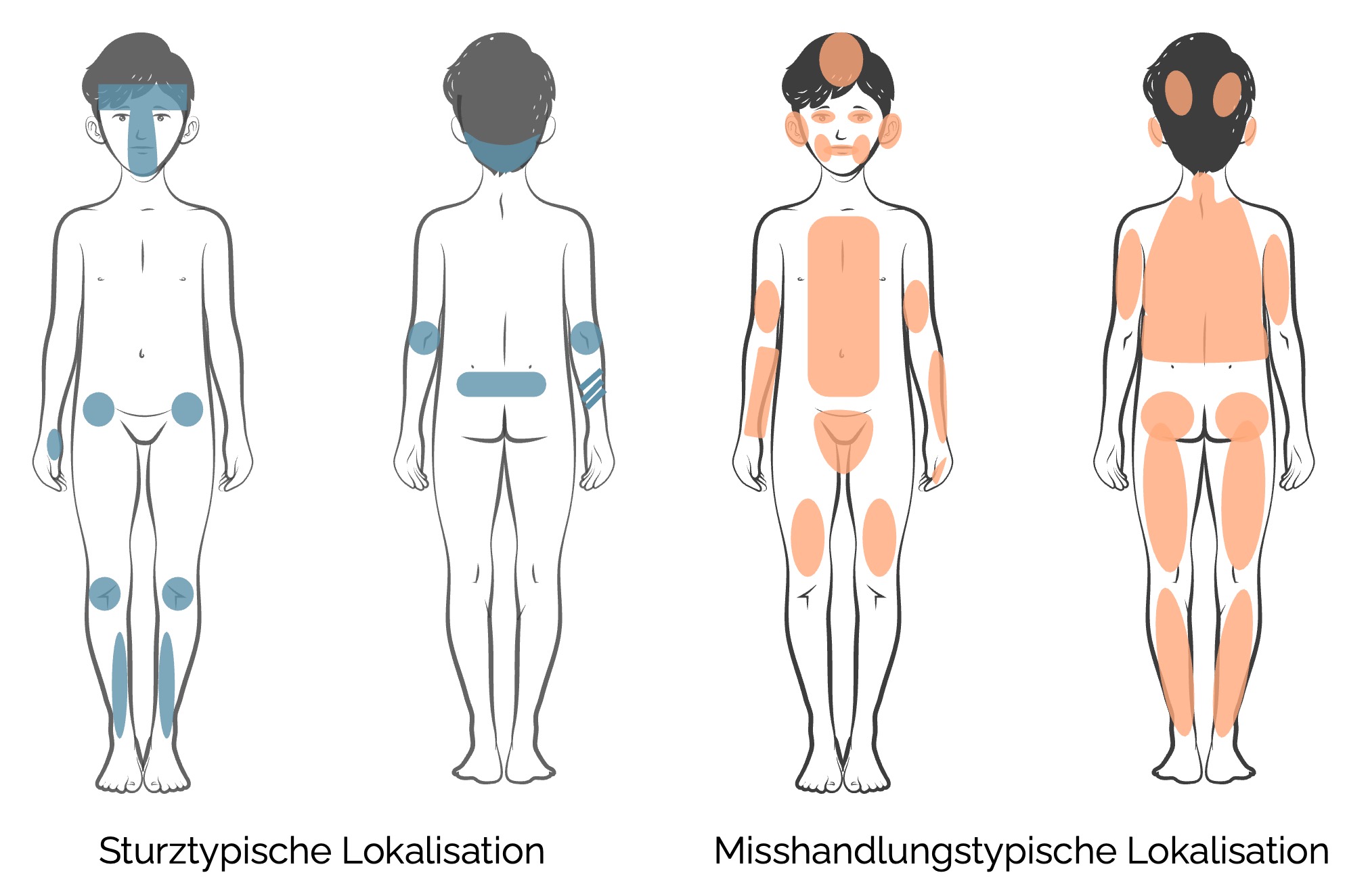 Sturztypische vs. misshandlungstypische Lokalisation von Verletzungen bei Kindern