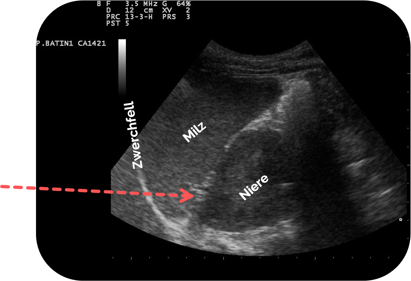 Normalbefund des Koller-Pouch: Zwischen Milz und Niere ist keine Flüssigkeit erkennbar
