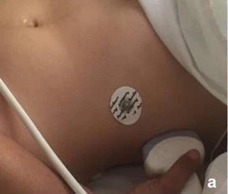 Sondenpositionierung zur Darstellung des Koller-Pouch