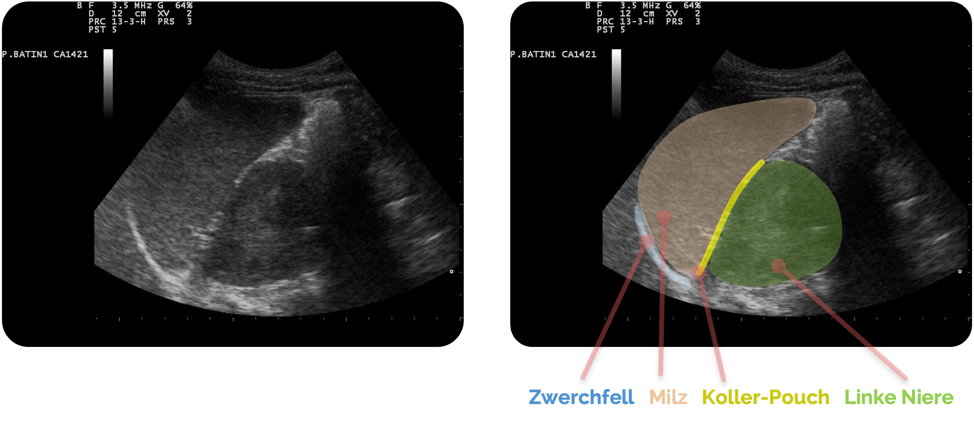 Normalbefund des Koller-Pouch: Zwischen Milz und Niere ist keine Flüssigkeit erkennbar