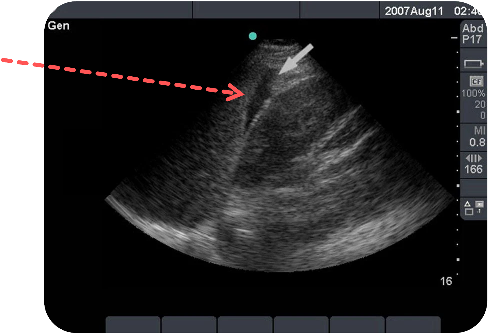 Freie Flüssigkeit im Koller-Pouch