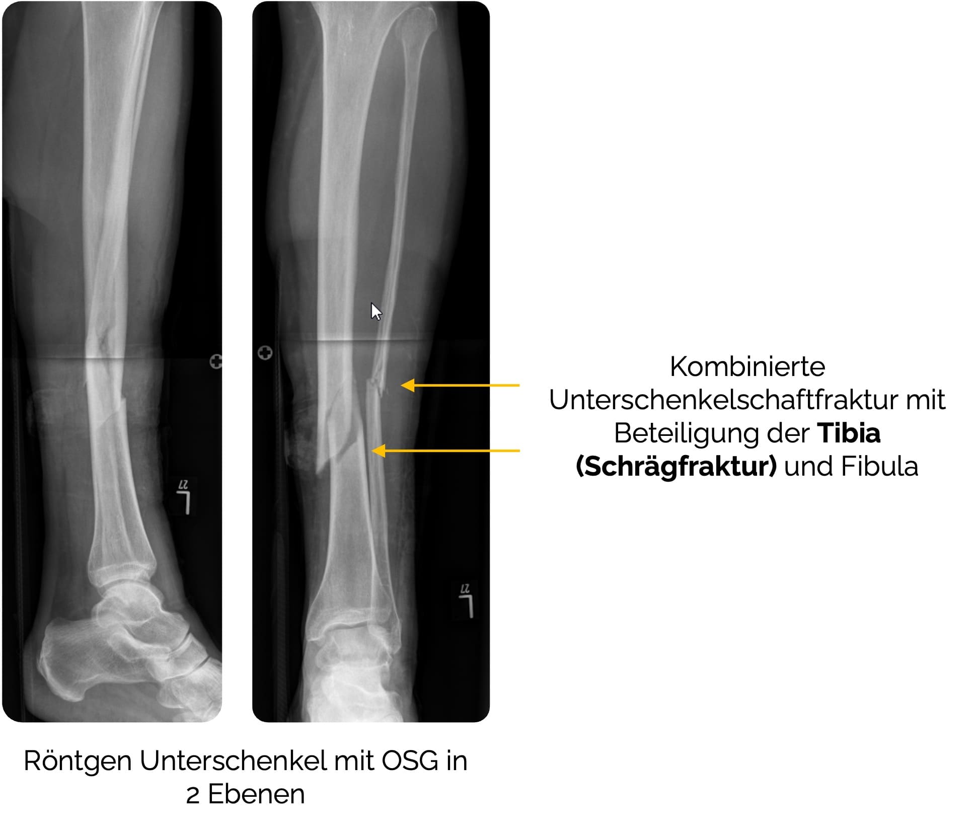 Kombinierte Unterschenkelschaftfraktur mit Beteiligung der Tibia (Schrägfraktur) und Fibula