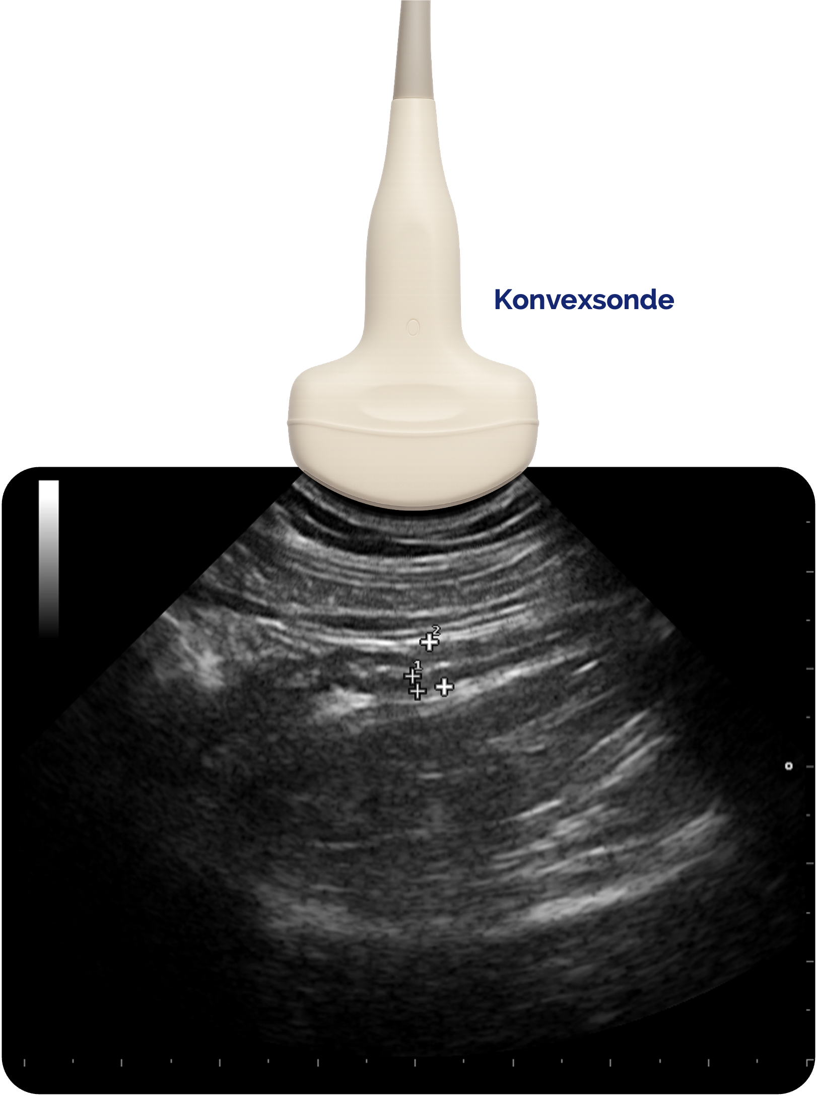 Kovexsonde - Darstellung des Appendix vermiformis
