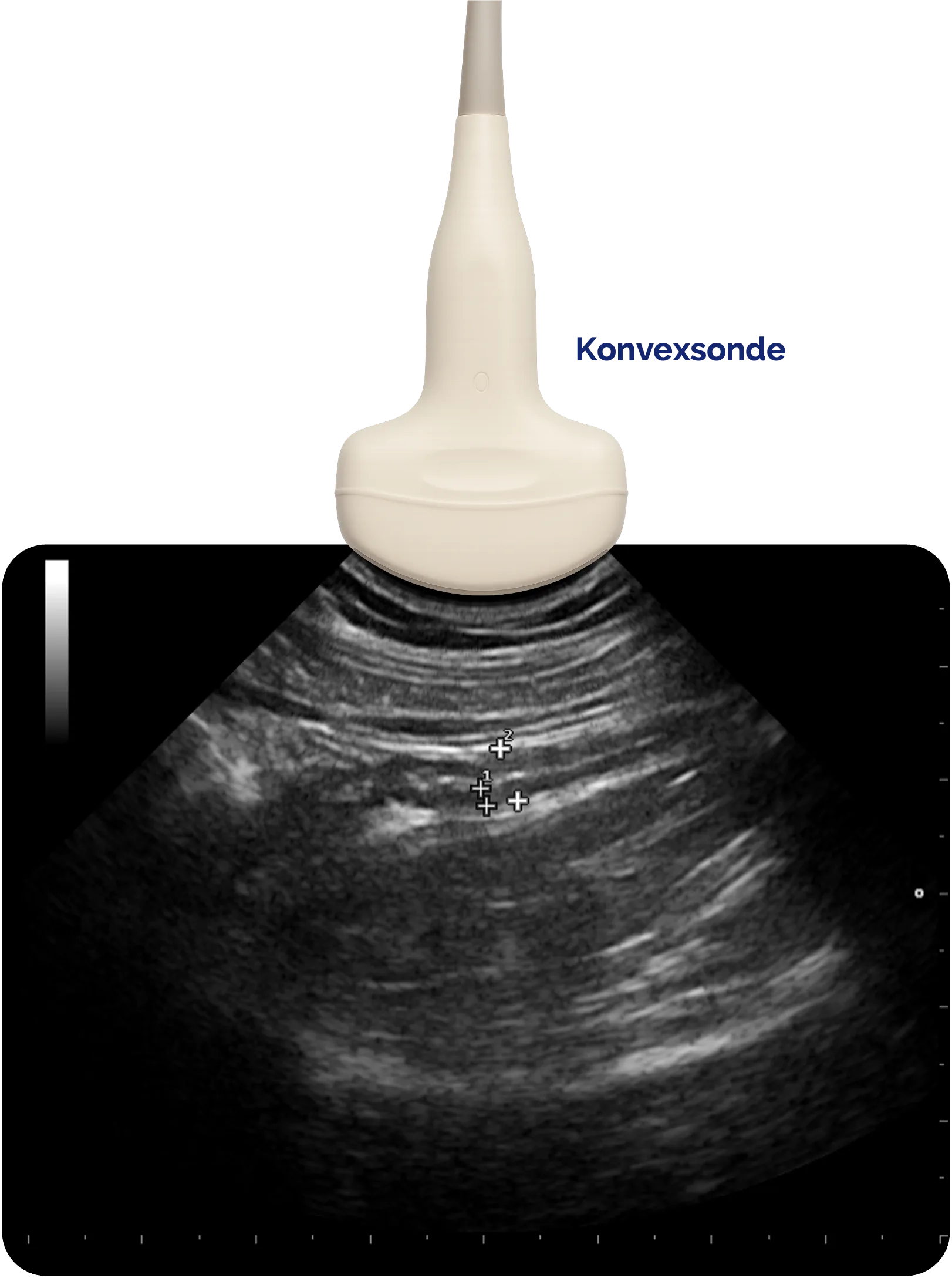 Kovexsonde - Darstellung des Appendix vermiformis