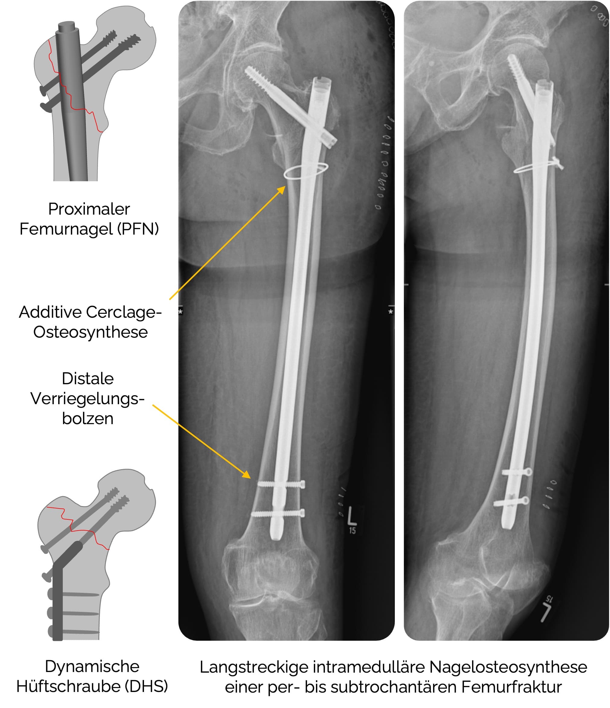 Langstreckige intramedulläre Nagelosteosynthese einer per- bis subtrochantären Femurfraktur
