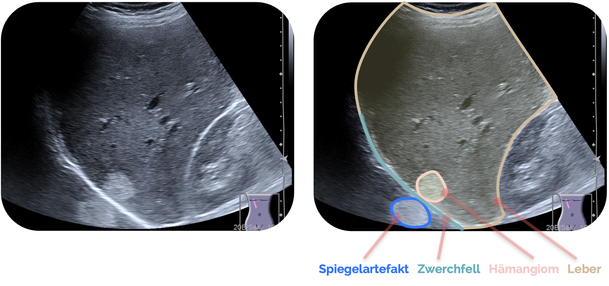 Leberhämangiom mit Spiegelartefakt