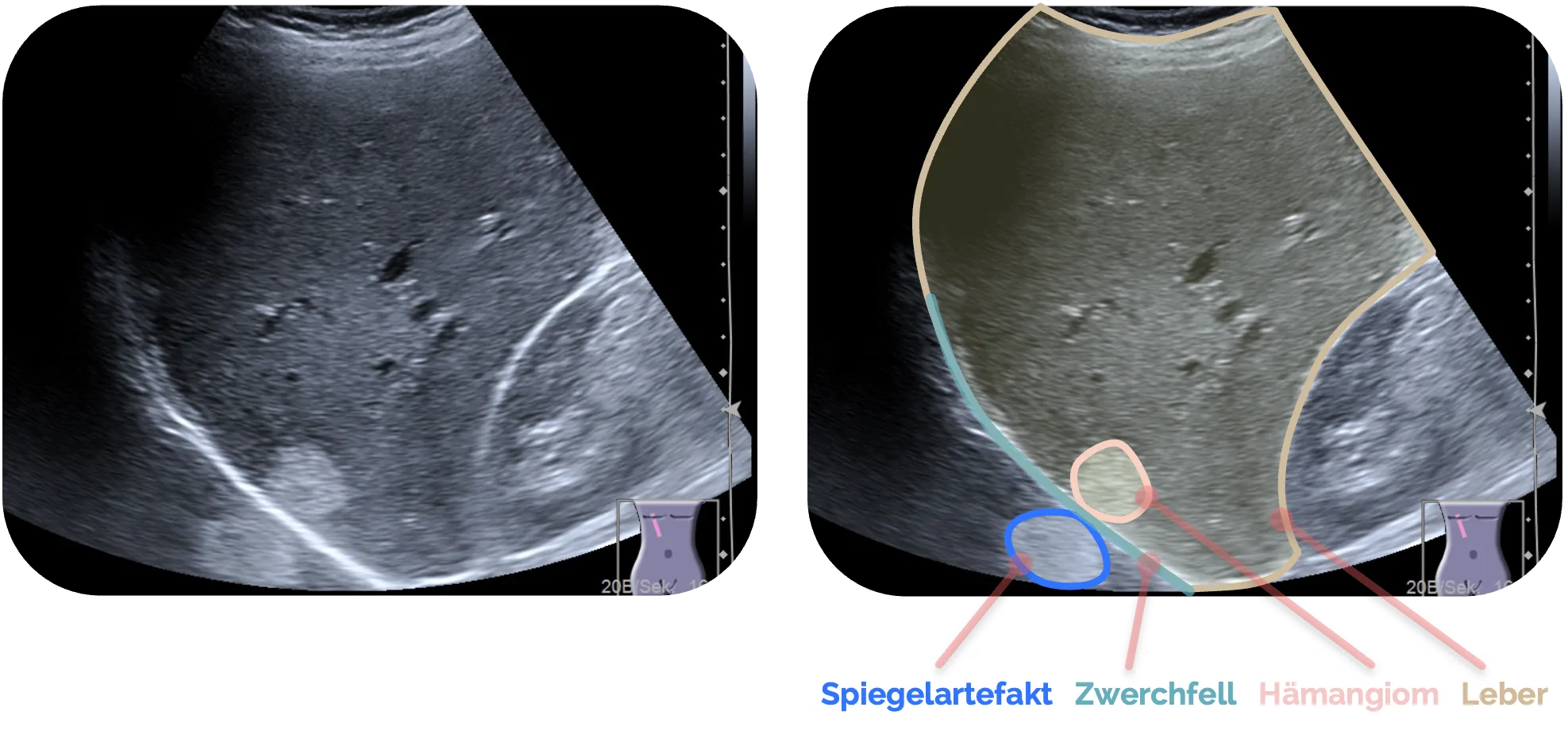 Leberhämangiom mit Spiegelartefakt