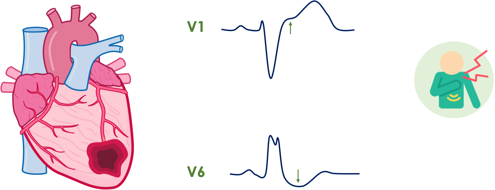 STEMI-Äquivalent: Linksschenkelblock