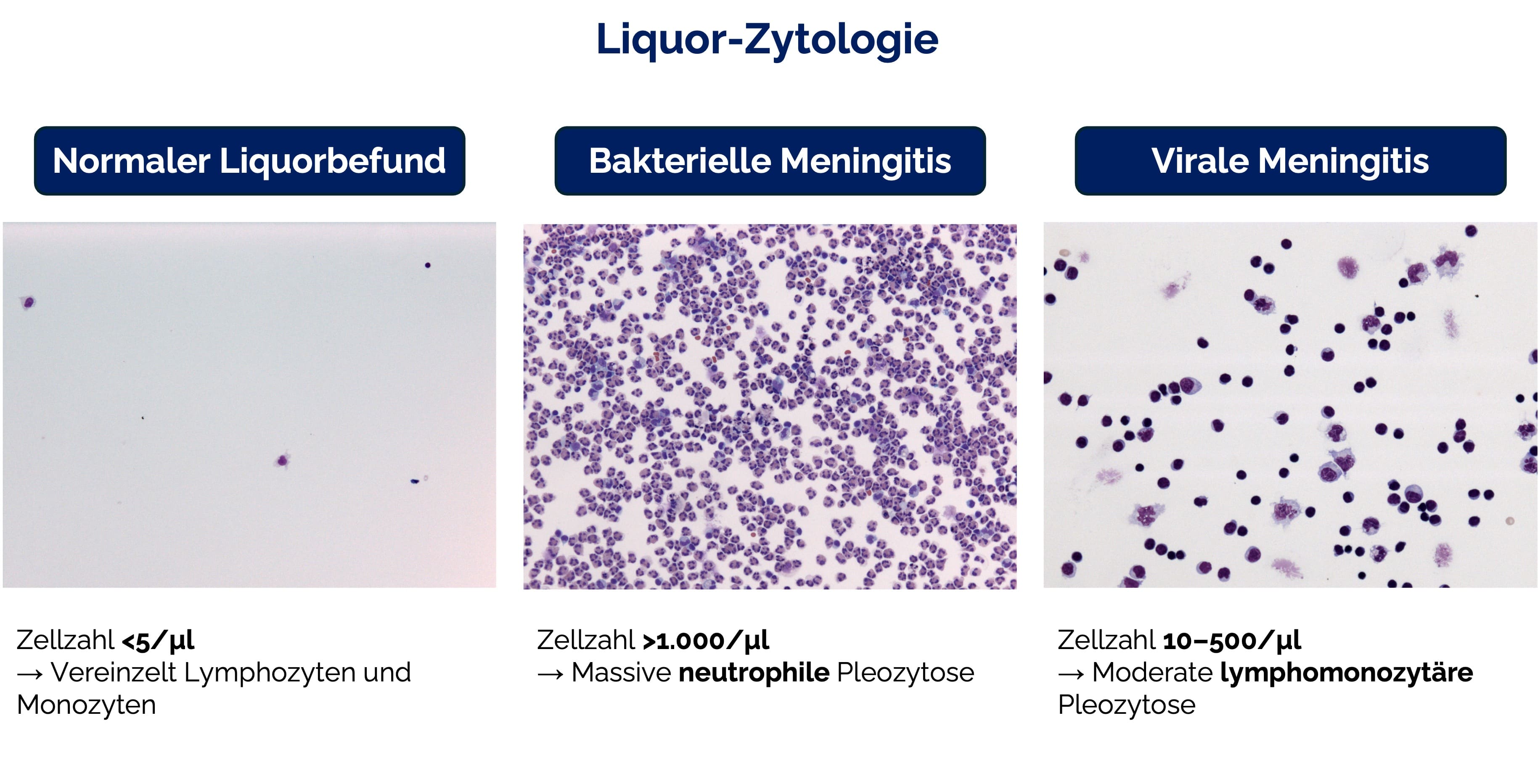 Liquor-Zytologie bei Meningitis