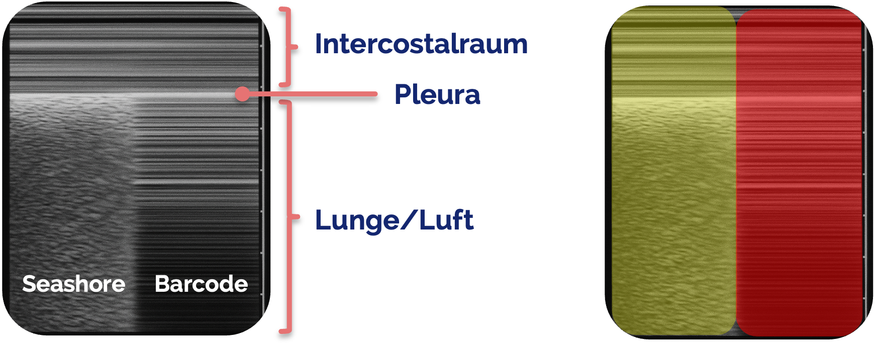 Schematische Darstellung des Lung-Point-Zeichens im M-Mode