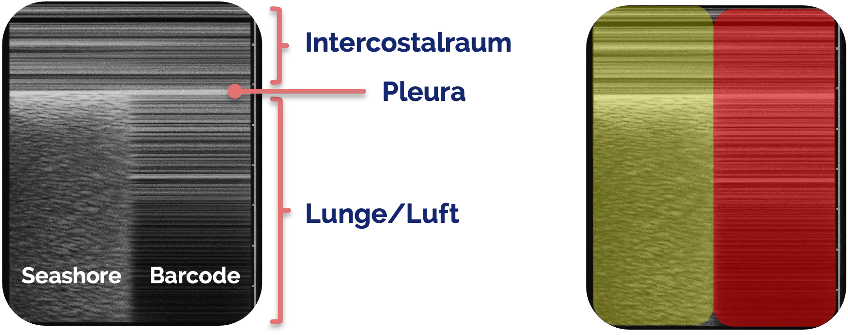 Schematische Darstellung des Lung-Point-Zeichens im M-Mode