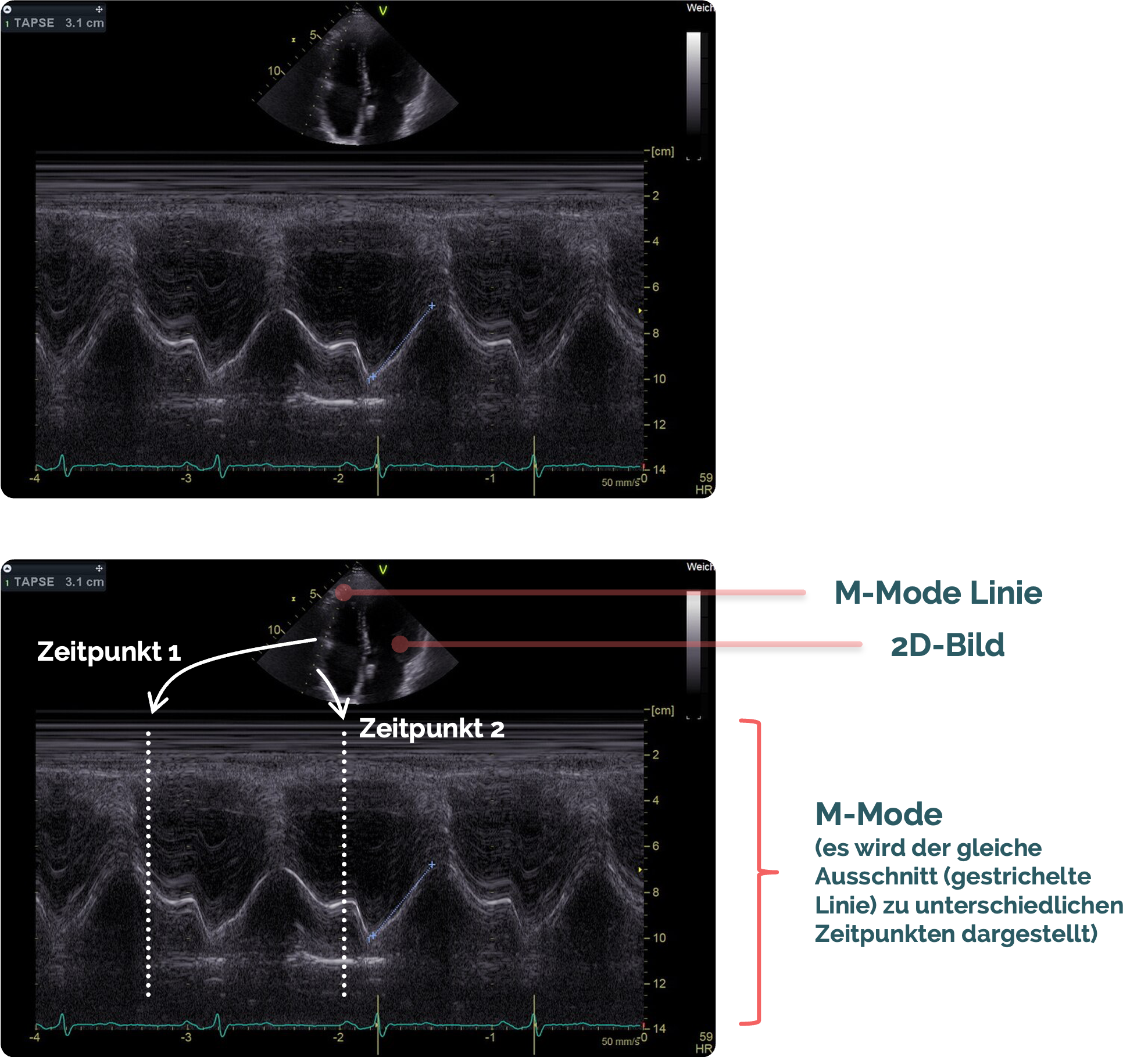 M-Mode - Herzultraschall im 4-Kammer-Blick von apikal, Messung der TAPSE