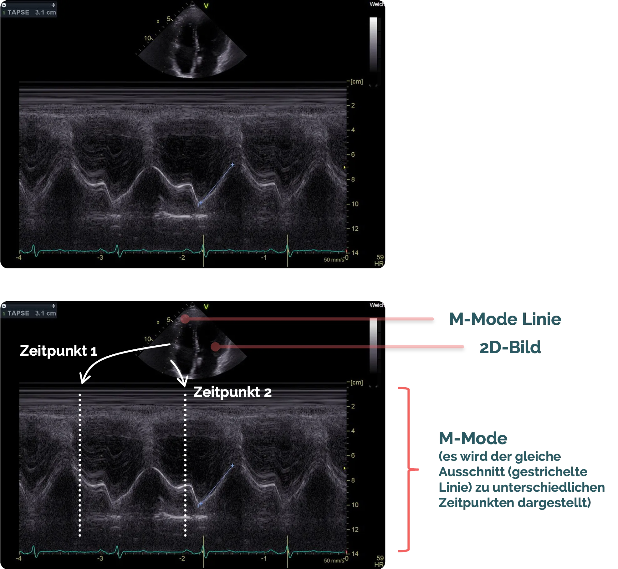 M-Mode - Herzultraschall im 4-Kammer-Blick von apikal, Messung der TAPSE