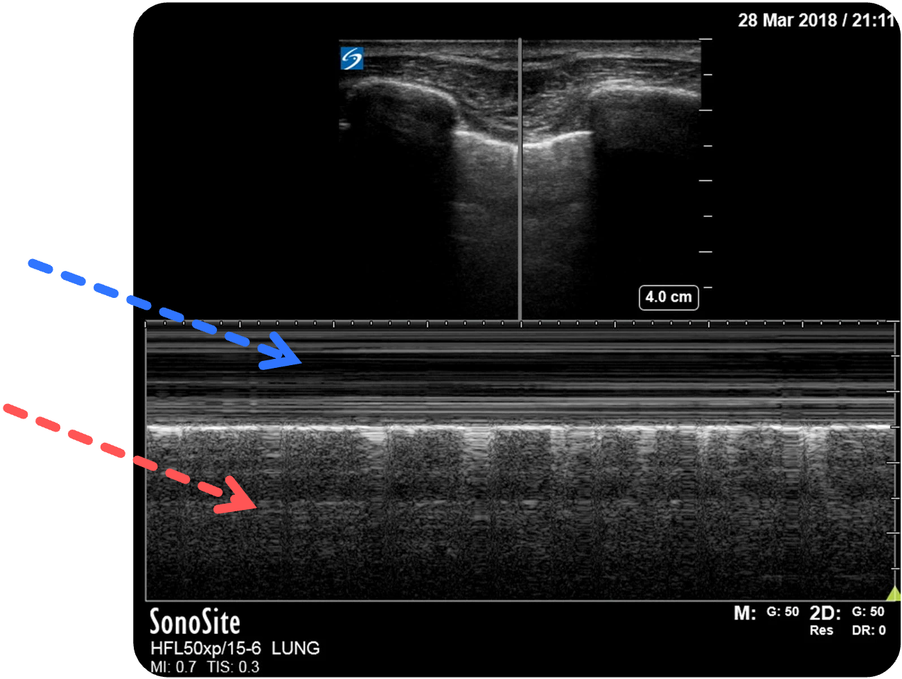 Normalbefund der Pleura im M-Mode, Seashore-Zeichen