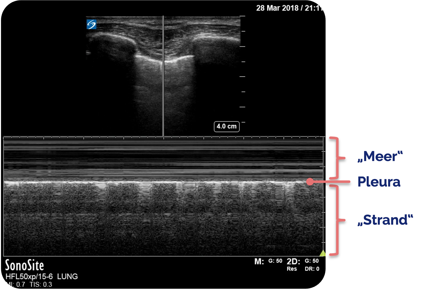 Normalbefund der Pleura im M-Mode, Seashore-Zeichen