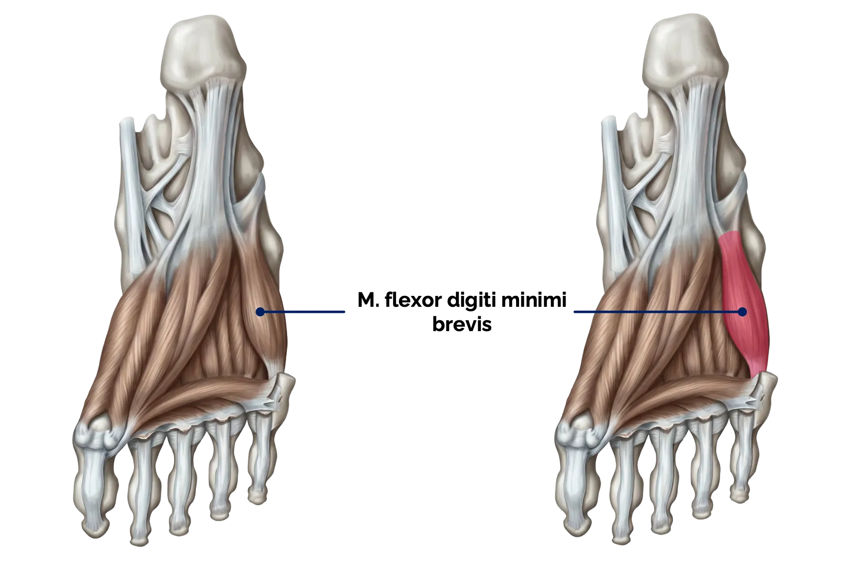 M. flexor digiti minimi brevis des Fußes