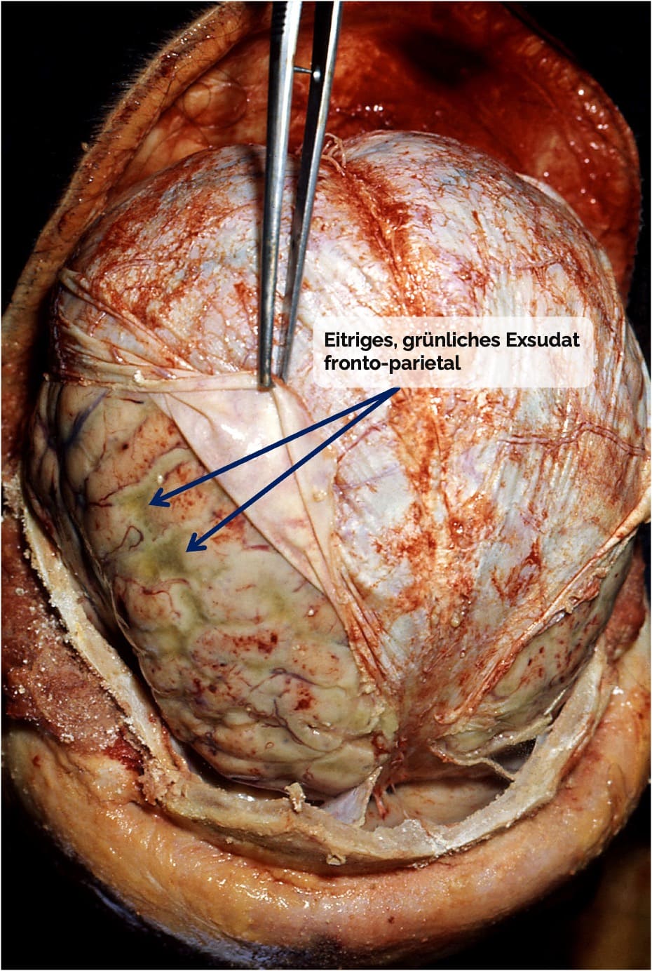Bakterielle Meningitis (Haubenmeningitis)