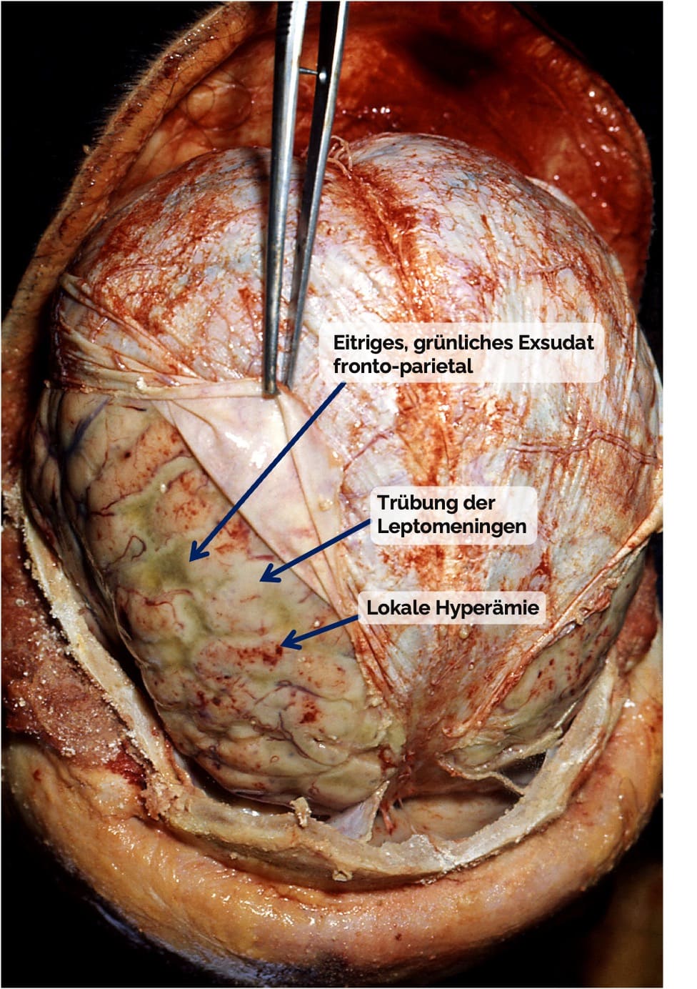 Bakterielle Meningitis (Haubenmeningitis)