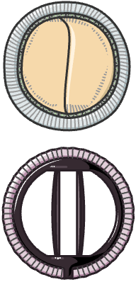 Biologische Herzklappe (oben) und mechanische Herzklappe (unten)