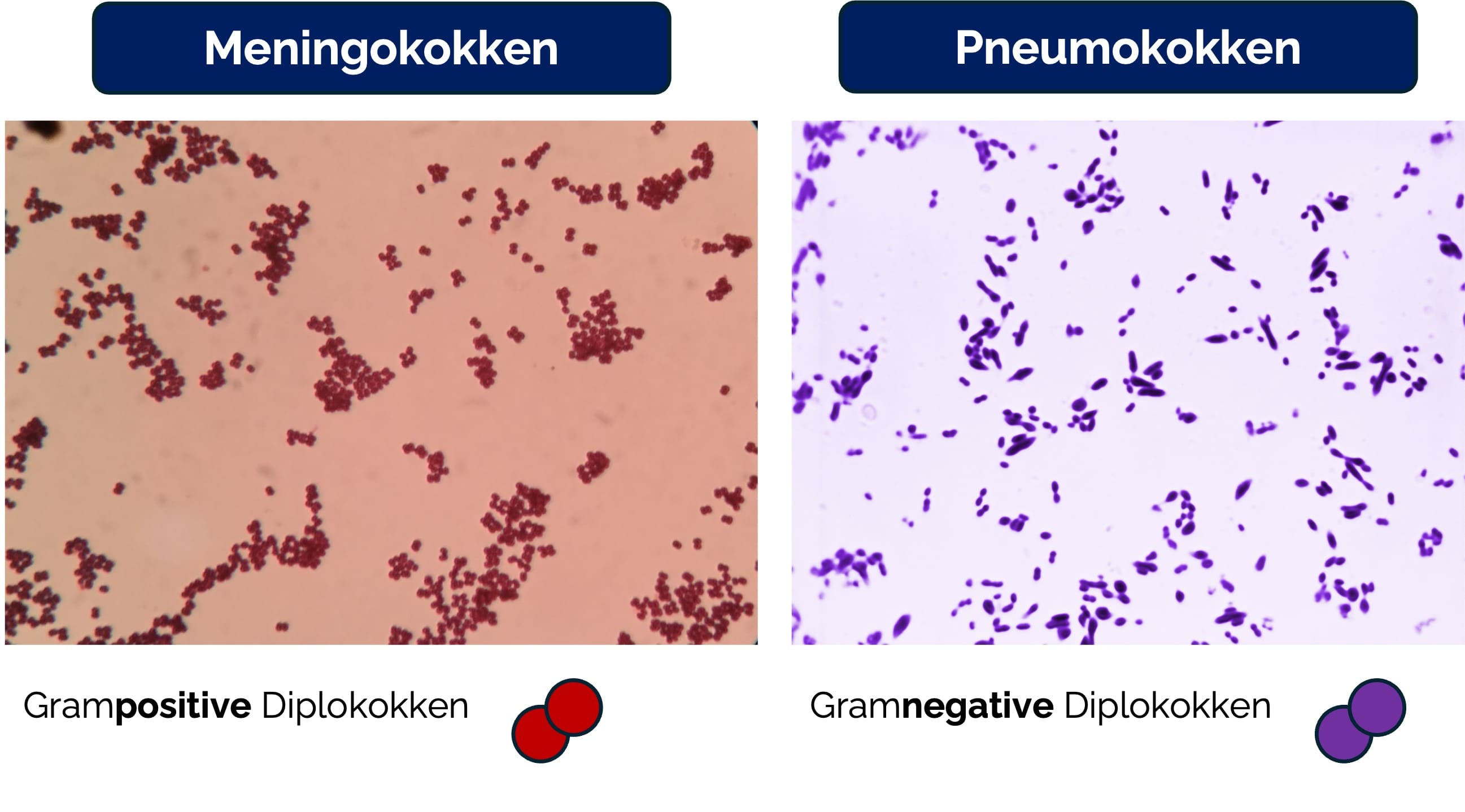 Erregermorphologie im Liquor bei bakterieller Meningitis