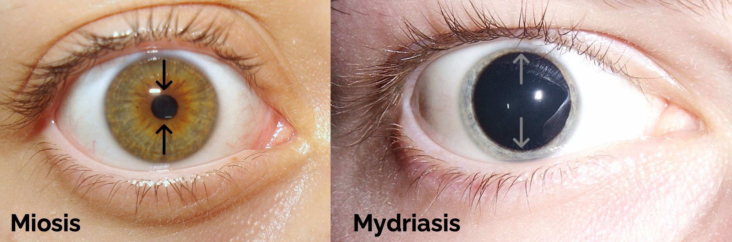 Miosis und Mydriasis – Pupillenreaktionen im Vergleich