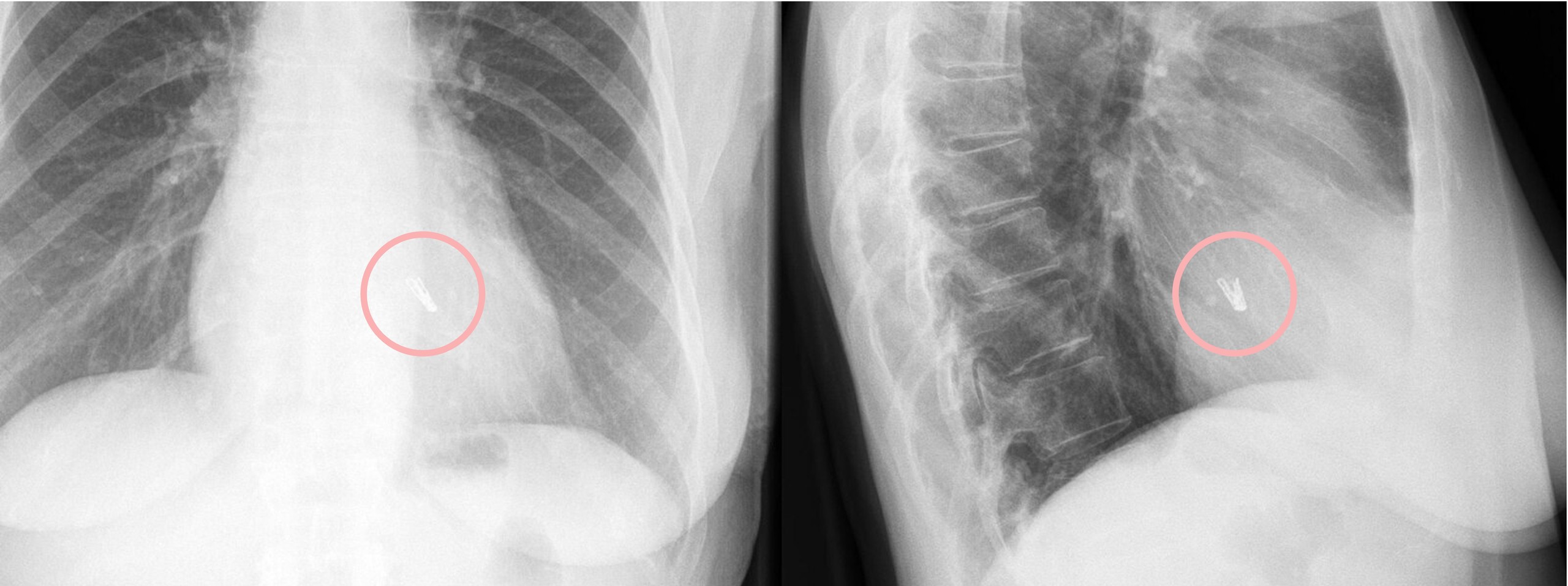 Mitraclip im Röntgen-Thorax