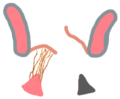 Papillarmuskelinfarkt mit Mitralklappenprolaps