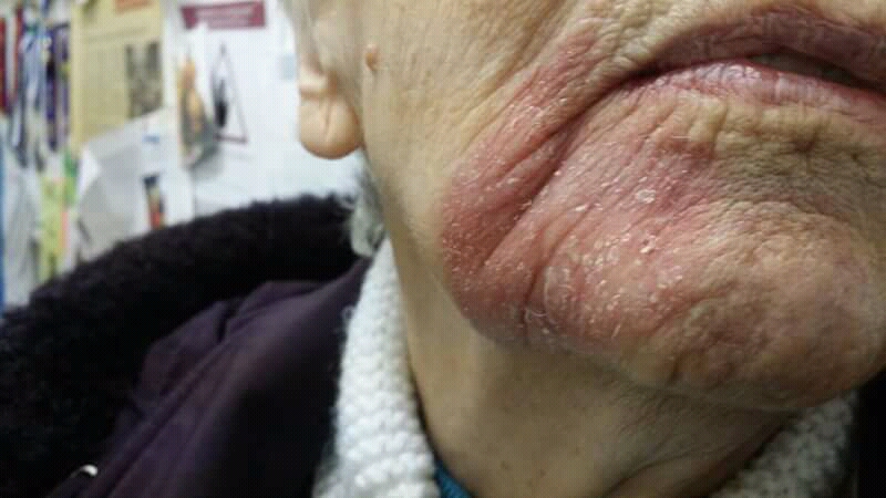 Morbus Bowen am Kinn einer älteren Frau