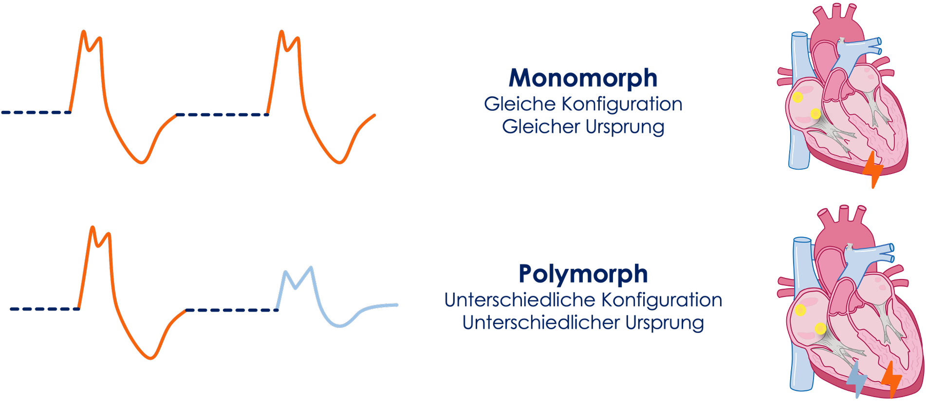 Morphologie und Besonderheiten von Extrasystolen