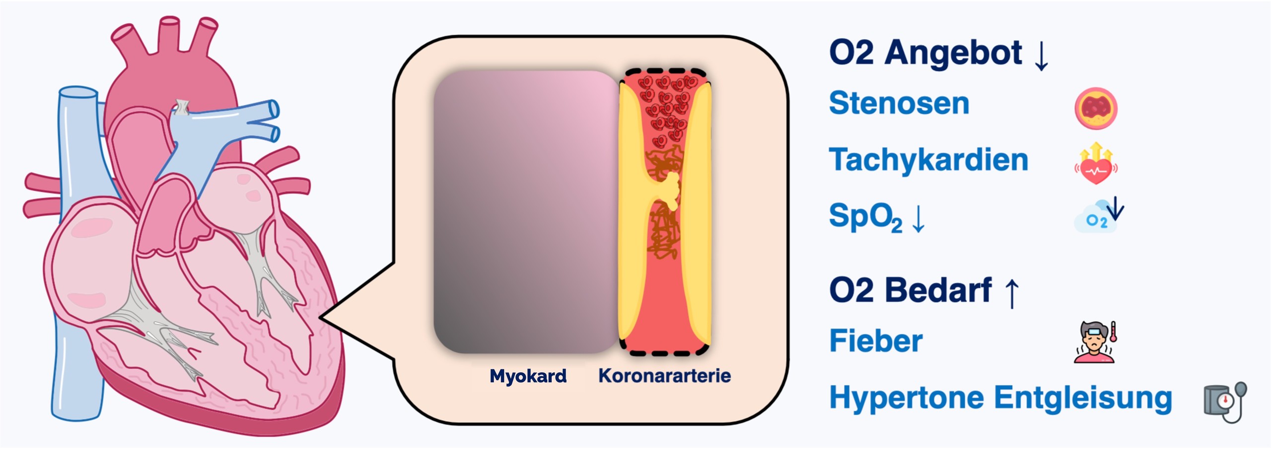 Pathophysiologie des akuten Koronarsyndrom