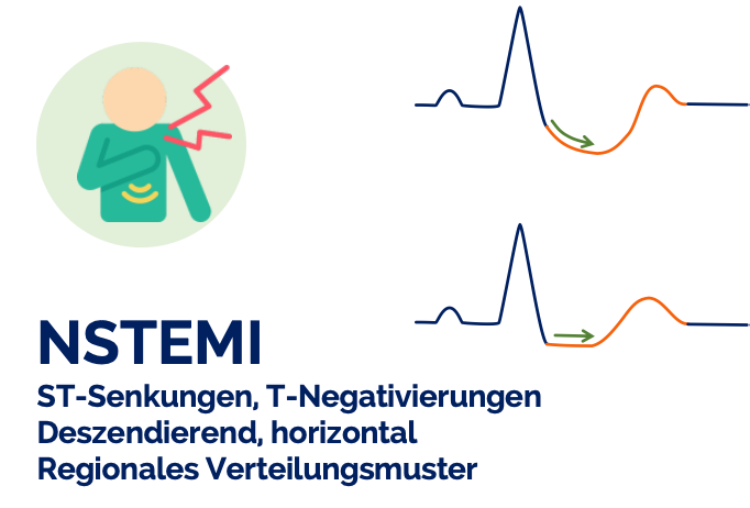 NSTEMI im EKG