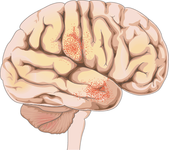 Makroskopischer Befund bei bakterieller Meningitis