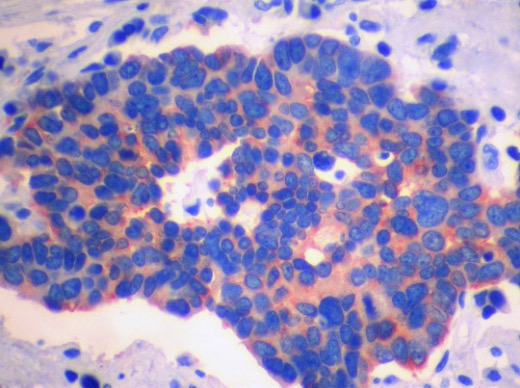 Neuroendokriner Tumor (positive Chromogranin A-Färbung)