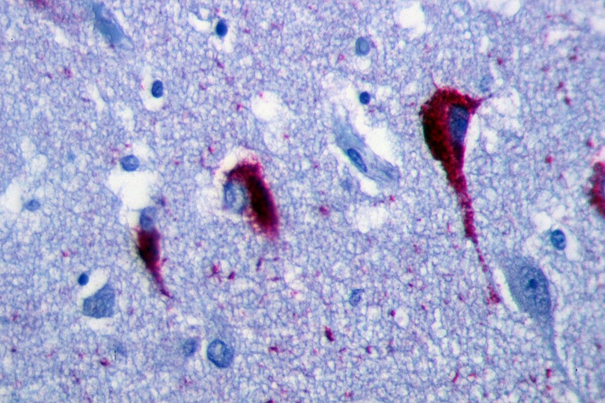 Neurofibrilläre Tangles
